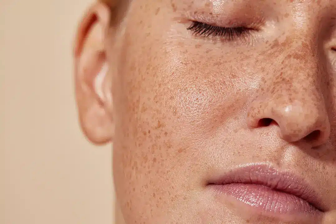 A Man with hyperpigmentation on his face