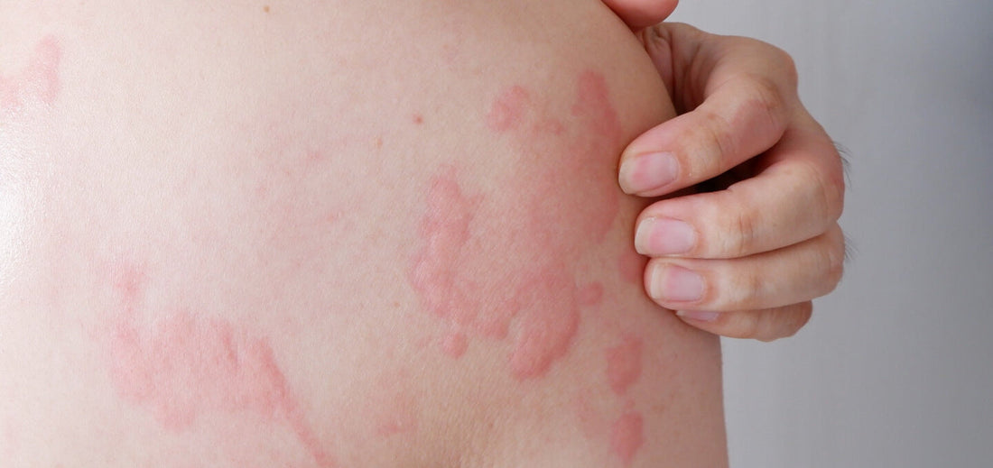 a man with hives itching his skin