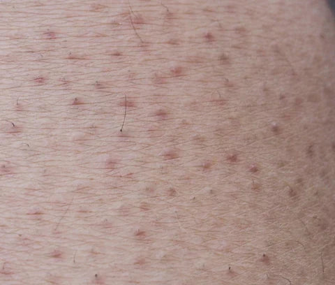 Visual image of Chicken Skin