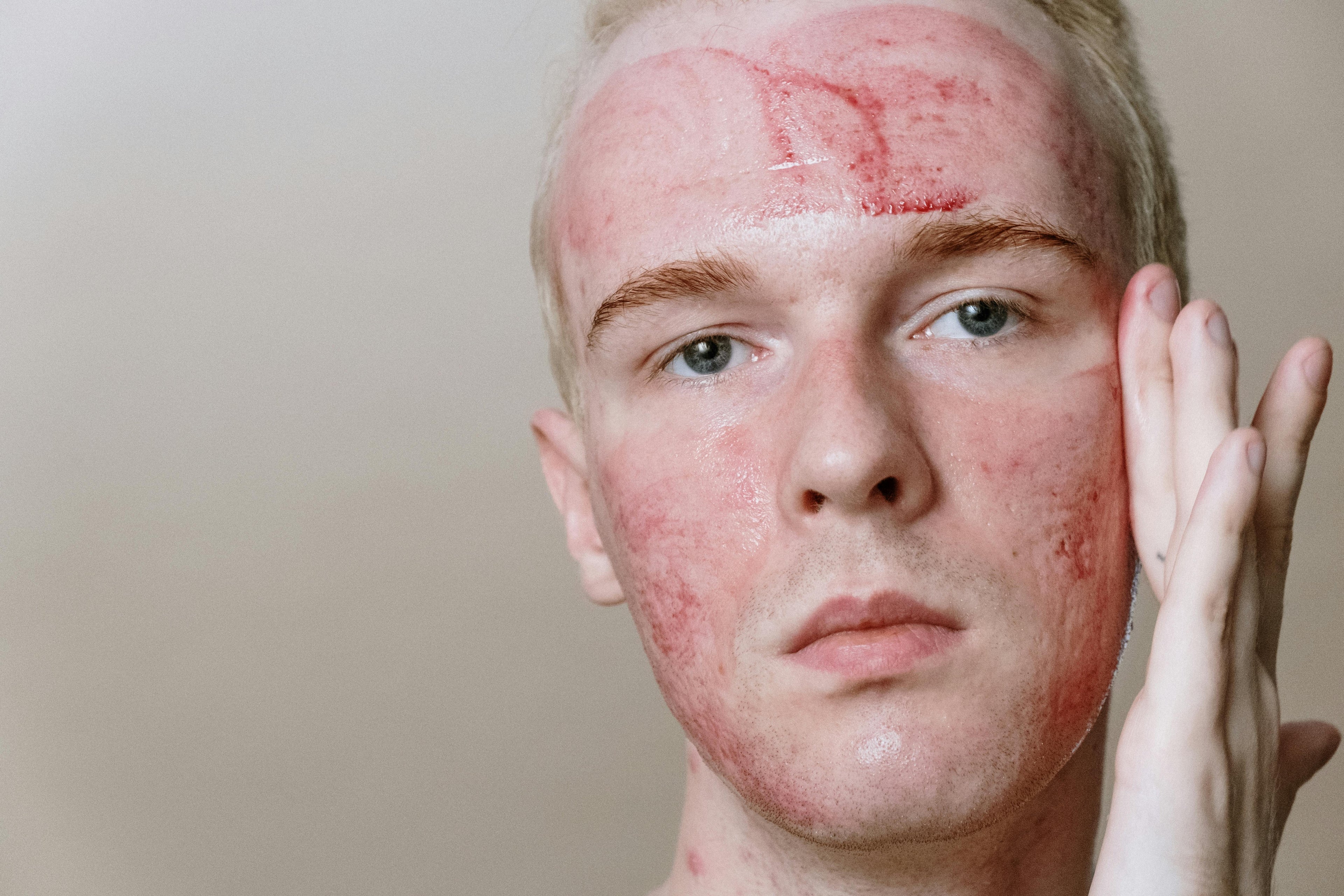 A Man with skin problems. 