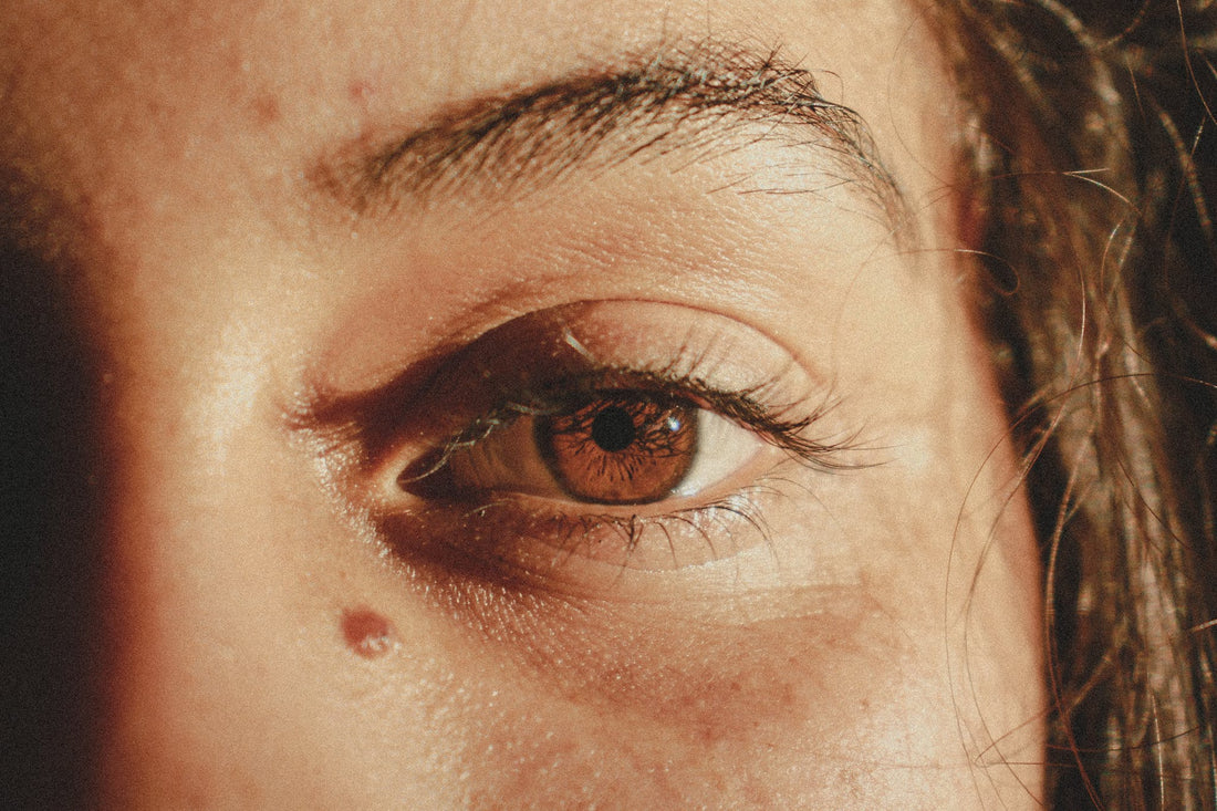skin tags near eyes of a woman